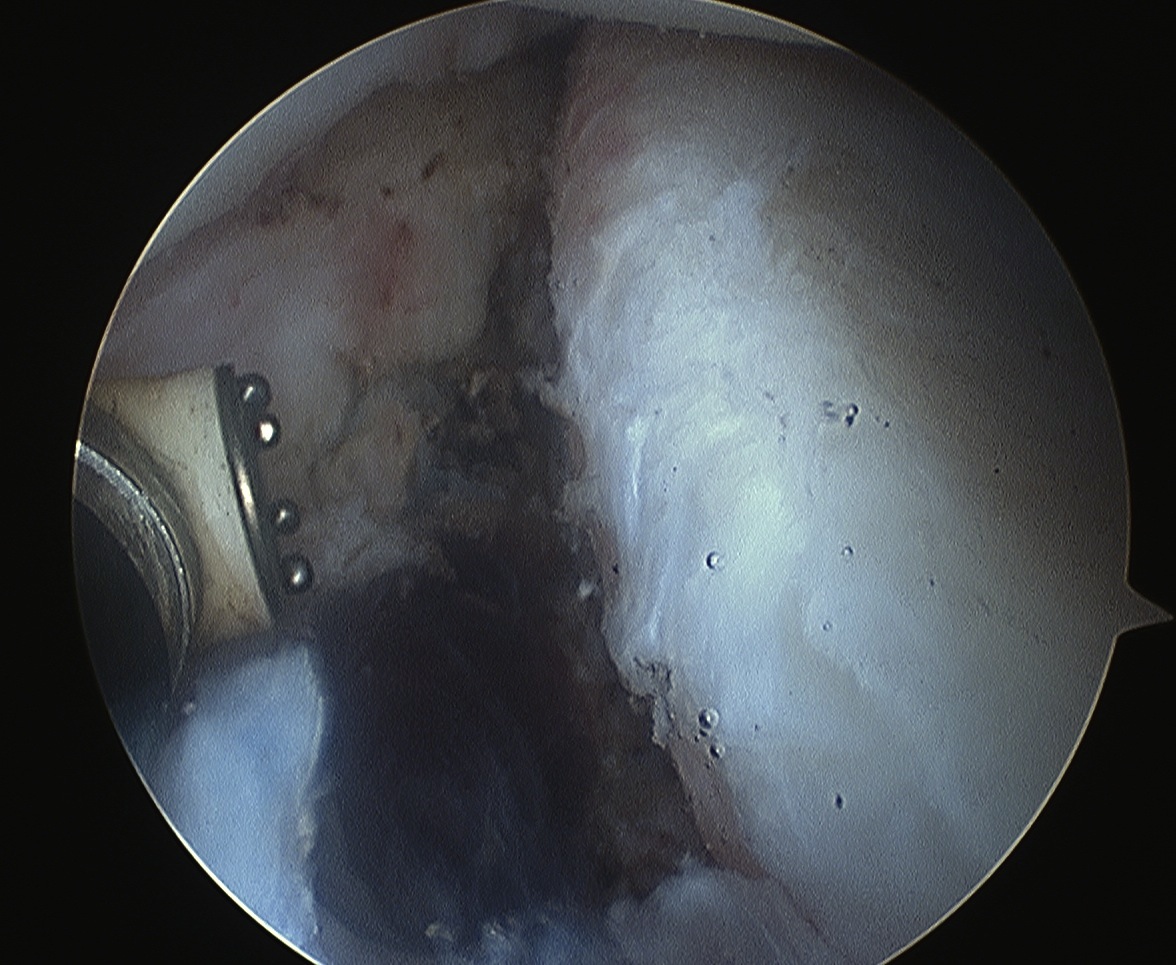 Shoulder Stabilisation Anterior Labral Mobilisation